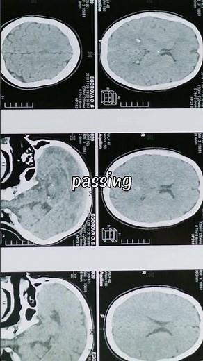 What happened to Albert Einstein's Brain