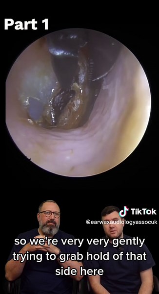 Dry Ear Wax Removal Techniques for Satisfying Results - Part 1