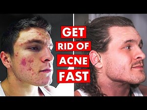 5 DO's & DON'TS To Get Rid of Acne FAST!