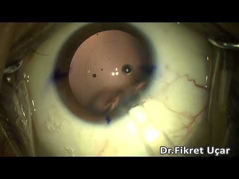 Tecnis SYNERGY Toric IOL Implantation