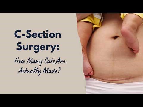 C Section Surgery: How Many Cuts Are Actually Made?