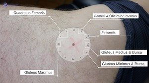 Greater Trochanter Palpation | Gluteal Tendinopathy (GTPS)