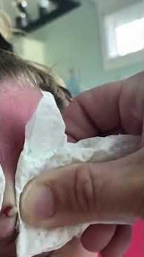 Cystic Acne Extractions Whiteheads - Blackheads Removal Today