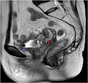 Laparoscopic anterior pelvic exenteration following concurrent chemoradiotherapy: how I do it