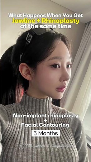 Korea Plastic Surgery | Facial Contouring & Rhinoplasty Before & After Transformation