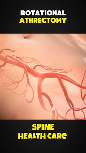 How Rotational Atherectomy is Performed 3D Animation #rotationalatherectomy #athrectomy #coronaryarterydisease | Spine Health Care