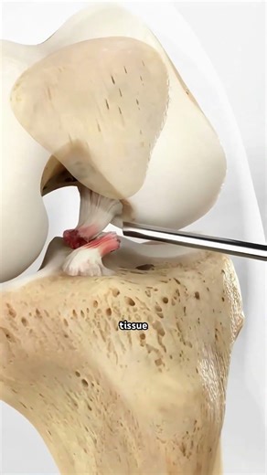 ACL Reconstruction Surgery | How a Torn ACL Is Rebuilt? (3D Animation) #aclrecovery #aclr