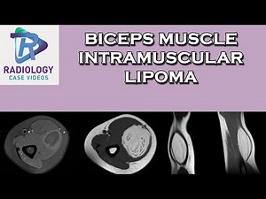 Biceps muscle intramuscular lipoma