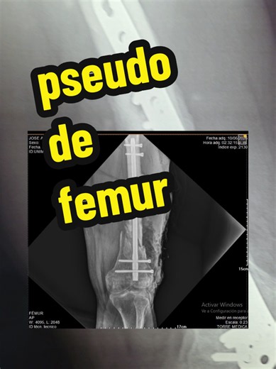 pseudo de femur operado retiro de placa y colocación clavo con legrado oseo escarificacion de jódete colocación de injerto oseo