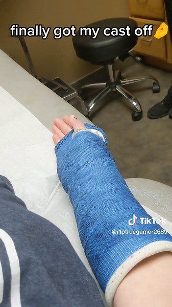 Cast Removal: The Moment I Got My Cast Off!
