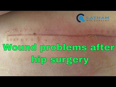 Wound problems after hip surgery