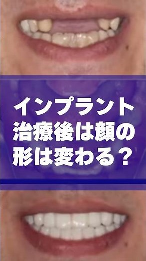 インプラント治療後は顔の形・表情はかなり変わる！？#shorts