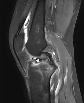 Tibial spine avulsion