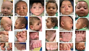 Severe birth defects found in 30 babies may be linked to fentanyl use during pregnancy