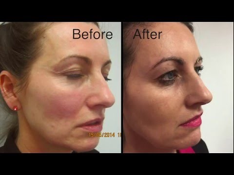 PLEXR Non-Surgical Blepharoplasty