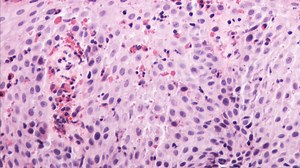 Upper GI Pathology - Physician's Channel - Mount Sinai New York