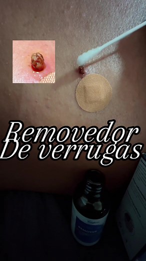 Como eliminar pequeñas verrugas con este liquido Removedor de verrugas bas estar eliminando tus verrugas desde la comodidad de tu casa y de manera fácil y segura #eliminaciondeverrugas #wartremover #BFCM #titokshopcreatorpicks ##tiktokshopfinds @Ragkun Brand store