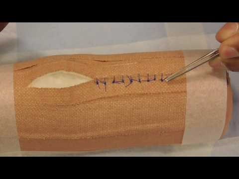 Suture Removal - simple interrupted