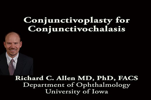 Conjunctivoplasty for conjunctivochalasis