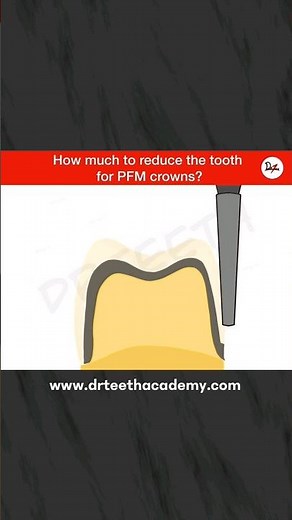 Tooth Preparation for PFM crowns. #dentistry