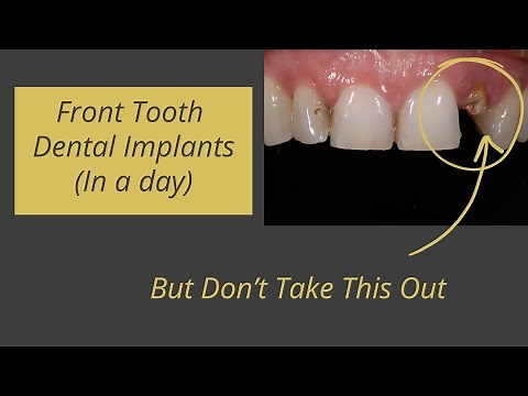 Immediate Dental Implants for Front Teeth (The Quick Way) - One Step Oral Surgery