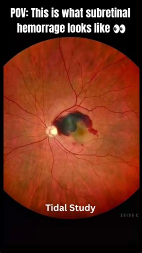 Subretinal hemorrhage | vision threatening eye emergency!