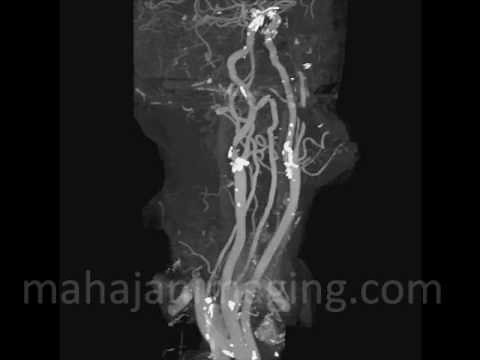 Carotid CT Angiography