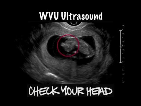 Check the Head: Fetal Anencephaly