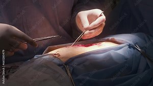Close up of surgery. Surgeon puts needle with thread in medical clip and starts to stitch wound. Professional medic finishes long operation in operating room. Medical staff at work in medical center.