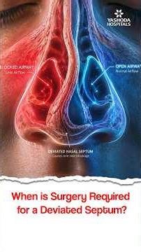 When is Surgery Required for a Deviated Septum? - Dr. Raghu Kumar. S CH