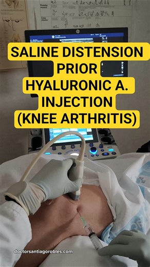 US-GUIDED SALINE DISTENSION PRIOR HYALURONIC ACID INJECTION IN KNEE ARTHRITIS