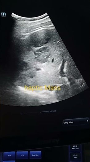 haptic Mass in ultrasound #ultrasound #medicaleducation #foryou #hapticmass #medicaleducation