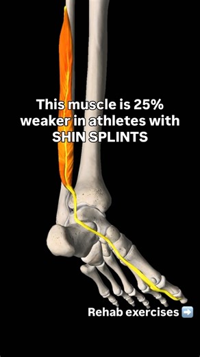 Struggling with SHIN SPLINTS? Start with these exercises