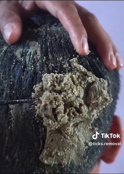 OMG!! Lots of Tiny ticks and Worms on a poor head😰#tickremoval #tick #health #head #hair