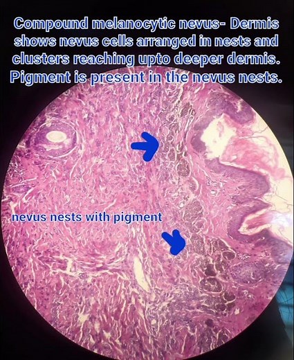 Compound melanocytic nevus #skintumors #melanocytes #histology #pathology