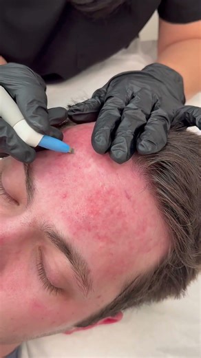 Non-Surgical Butt Fat Removal