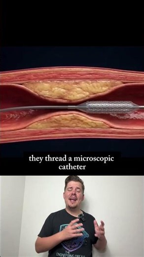 This Tiny Cage Saves You From Heart Attacks 🩸
