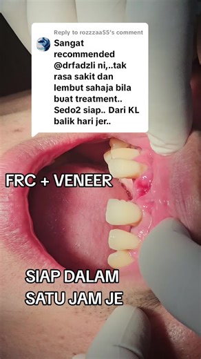 Veneer Gigi Review: Transform Your Smile in One Hour