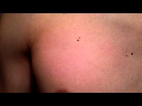 Right pectoral muscle twitching.