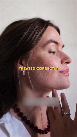 Understanding Sun Damage and Acne Marks on Skin Tone