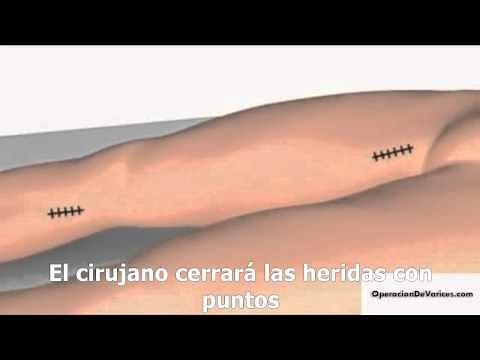 Operación de várices, el procedimiento paso a paso