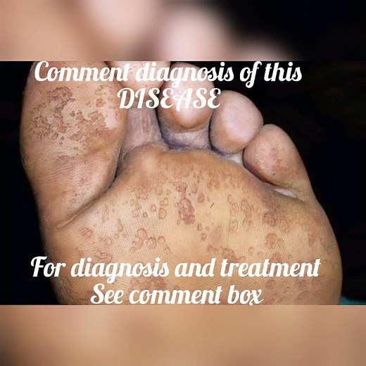diagnosis and treatment of pitting keratolysis by Dr.AMARNATH JHA