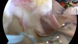 Arthroscopic Biceps Tenodesis with Lasso Loop