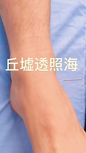 🎥 This video demonstrates how to needle Qiuxu (GB40) with penetration to Zhaohai (KI6). 📖 A clinical study published in the Western Journal of Traditional Chinese Medicine (2022, Vol.35 No.11) showed that this technique can significantly improve the surface myoelectric RMS values of the tibialis anterior and gastrocnemius muscles in ischemic stroke patients with foot varus. ✨ What does this mean? • Supports motor function recovery in stroke rehabilitation • Balances Yin–Yang by connecting the 
