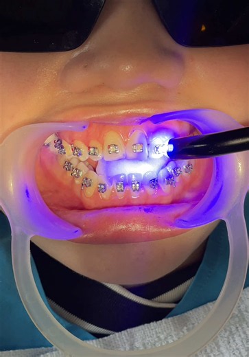 Bright Smile Dental Hospital: Braces in Cambodia
