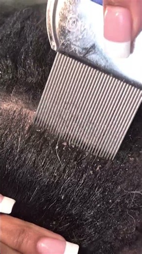 Scratching the dandruff out his flaky scalp