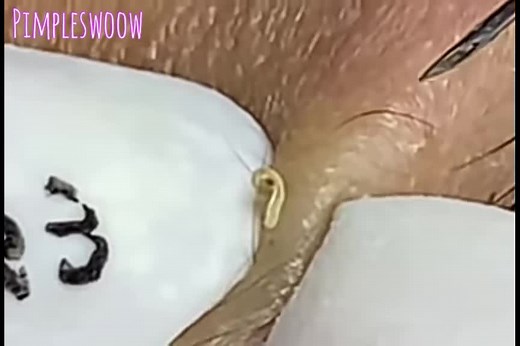 pimpleswoow on TikTok