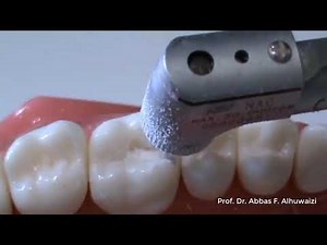 Class 2 cavity preparation for amalgam restorations 0