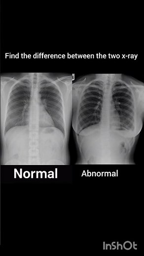 Normal vs Pleural Effusion X-ray | Spot the Difference! #Radiology #ChestXray#educational#routine.