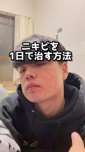 ニキビを一日で治す方法
